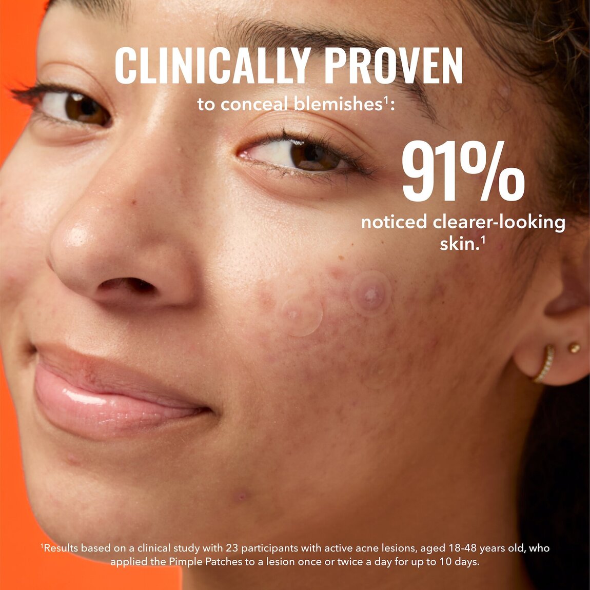 pimple-patches-o6 zb_p.jpg